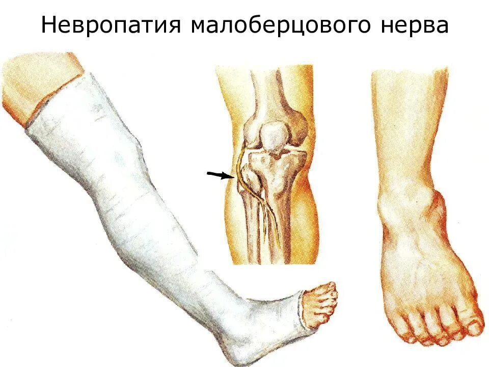 Дистальная нейропатия малоберцового нерва. Неврит малоберцового нерва анатомия. Туннельный синдром малоберцового нерва. Туннельный синдром малоберцового нерва симптомы. Большеберцовая нейропатия