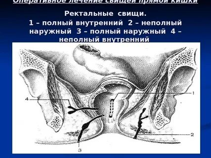 Свищ операция сколько длится