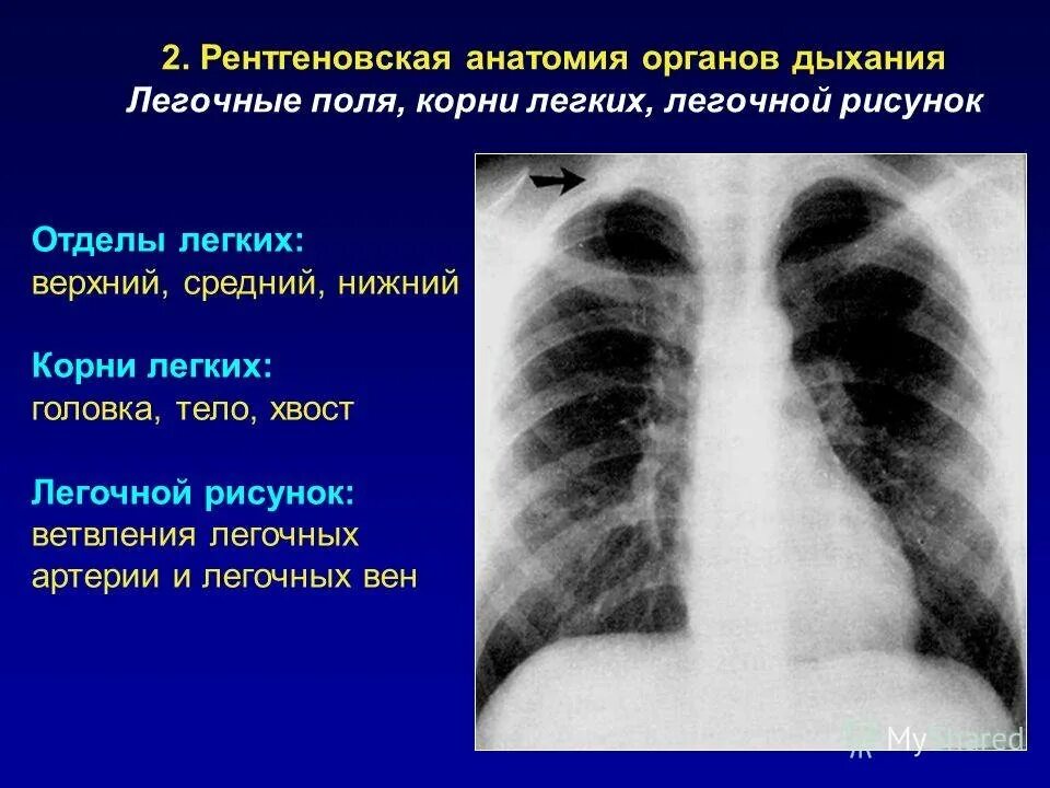 Изменения корня легкого. Отделы корня легкого. Отделы корня легкого на рентгенограмме. Оценка корня легкого на рентгене.