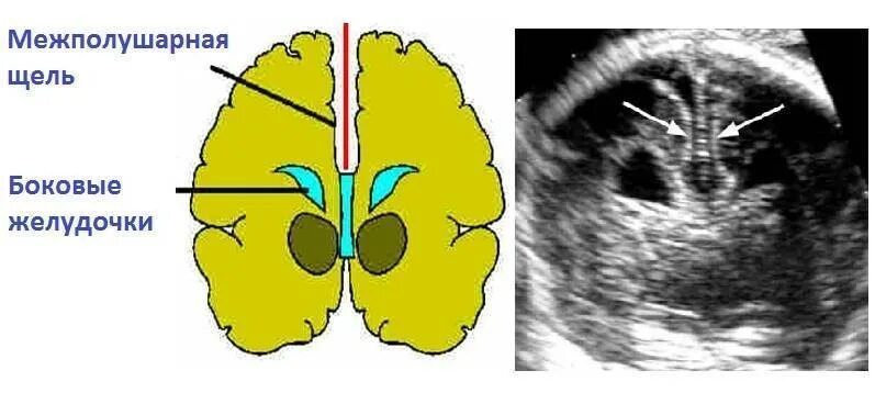 Межполушарная щель головного мозга. Нейросонография головного мозга грудничка норма. Строение головного мозга на НСГ. Расширение межполушарной щели. Расширение желудочков дети