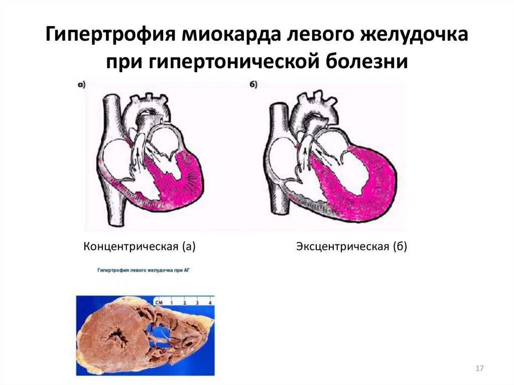 Гипертоническая болезнь и гипертрофия левого желудочка. Вид гипертрофии миокарда при гипертонической болезни. Гипертрофия левого желудочка сердца вид гипертрофии. Концентрическая гипертрофия левого желудочка ЭХОКГ. Миокард правого желудочка сердца