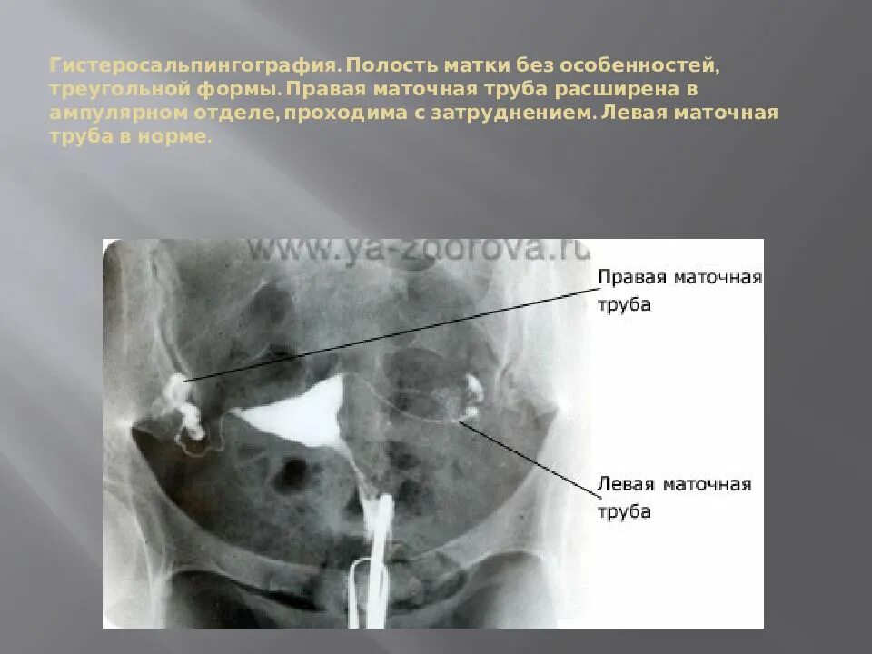 Форма полости матки. Расширенная маточная труба. Ампулярном отделе маточной трубы. Ампулярные отделы маточных труб.