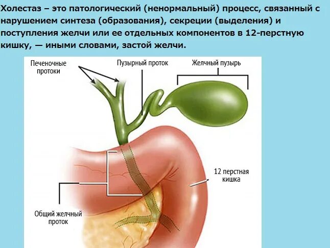 Застой в печени симптомы. Холестаза желчного пузыря. Желчь застаивается в печени. Холестаз и желчный проток. Лекарства при холестазе желчного пузыря.