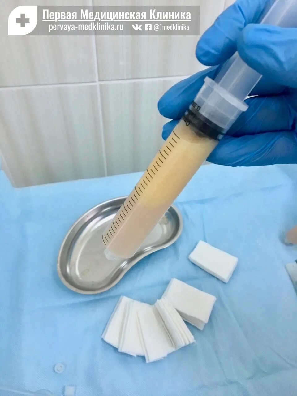 Био остео имплант тазобедренного. Биоимплант сустава bio-osteo. Биоимплант коленного сустава. Био остео имплант тазобедренного. Биоимплант коленного сустава.