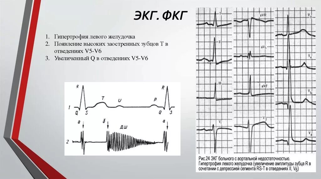 Гипертрофия левого желудочка на ЭКГ. Усиление ECG на ЭКГ. Гипертрофия лж на ЭКГ. ФКГ при гипертрофии левого желудочка. Экг преобладание левого желудочка