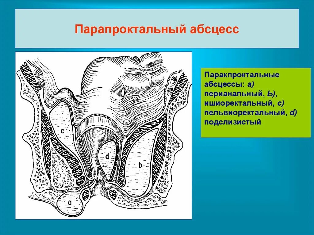 Хирургические заболевания прямой кишки. Подслизистый абсцесс прямой кишки. Пельвиоректальный парапроктит границы. Пельвиоректальный абсцесс. Ишиоректальный парапроктит абсцесс.