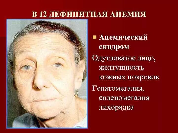 Анемия больные