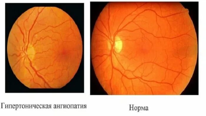 Гипертоническая ретинопатия глазное дно. Травматическая ретинопатия. Почечная ретинопатия глазное дно. Ангиопатия и ретинопатия сетчатки. Ангиопатия сосудов сетчатки что это