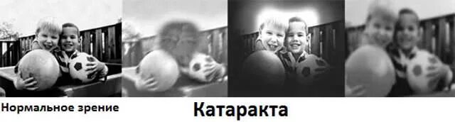 Как видят при катаракте. Как видит человек с катарактой. как видят при катаракте фото. как видит человек с катарактой фото.