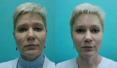 Убрать малярные мешки под глазами косметолог