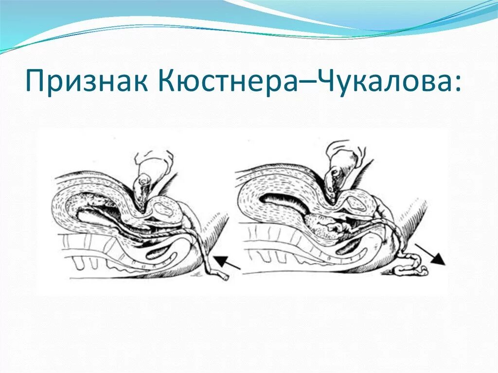 Признак отделения последа кюстнера-чукалова. Признаки отделения плаценты кюстнера-чукалова. Признак отделения плаценты кюстнера чукалова. Признак отделения последа кюстнера-чукалова. Признаки отделения плаценты кюстнера-чукалова.