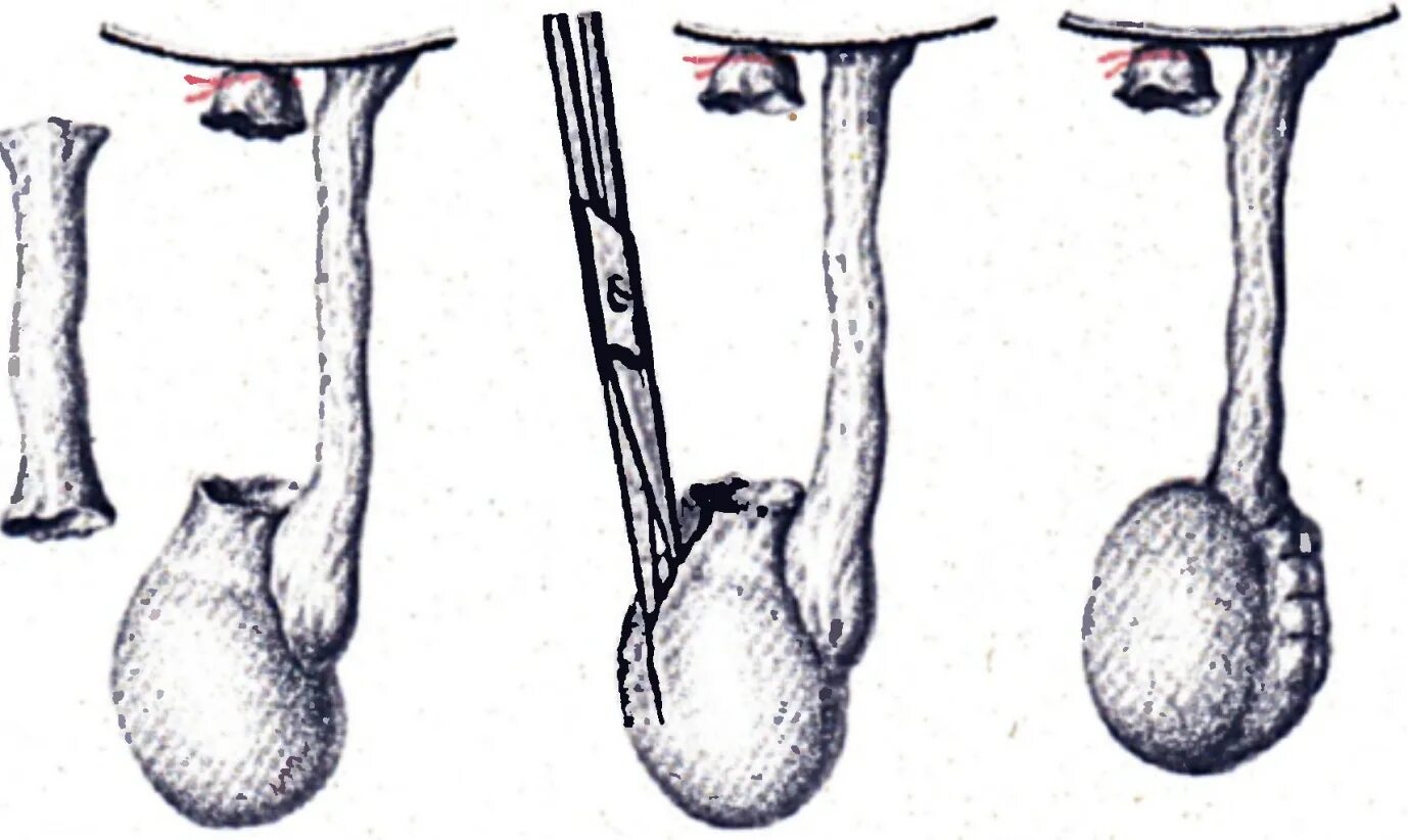 Операция Винкельмана при водянке оболочек яичка. Операция Росса при водянке яичка у ребёнка. Операция Винкельмана Бергмана. Операция Винкельмана и Бергмана при водянке яичка. Ниже яиц у мужчин