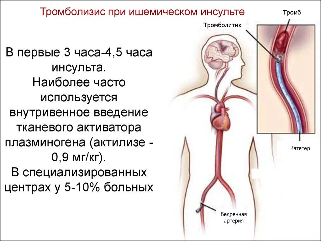 Тромбы после инсульта