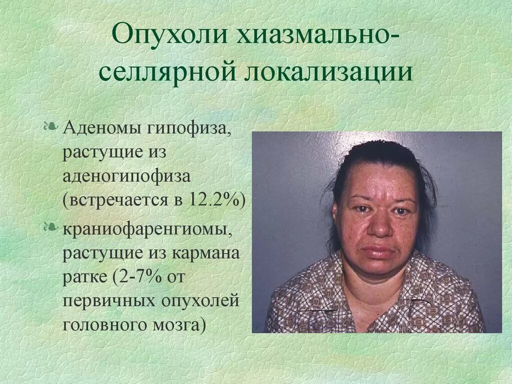 Аденома гипофиза симптомы. Соматотропная аденома гипофиза. Объемное образование гипофиза. Гормонально активной опухоли аденогипофиза. Гипоталамо- гипофизарные опухоли.