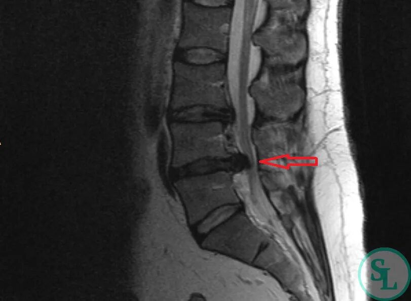 L4 l5 отдел позвоночника протрузия. Протрузии l4 l5. Грыжа позвоночника l4 l5. Протрузия l4-l5. Диск l4-l5.