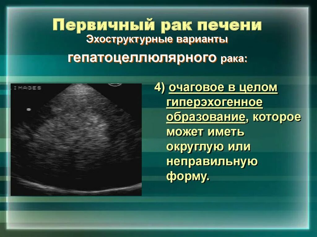 Округлые образования печени. Гиперэхогенные образования в печени на УЗИ. Гиперэхогенные структуры на УЗИ печени. Очаговые образования в печени на УЗИ.