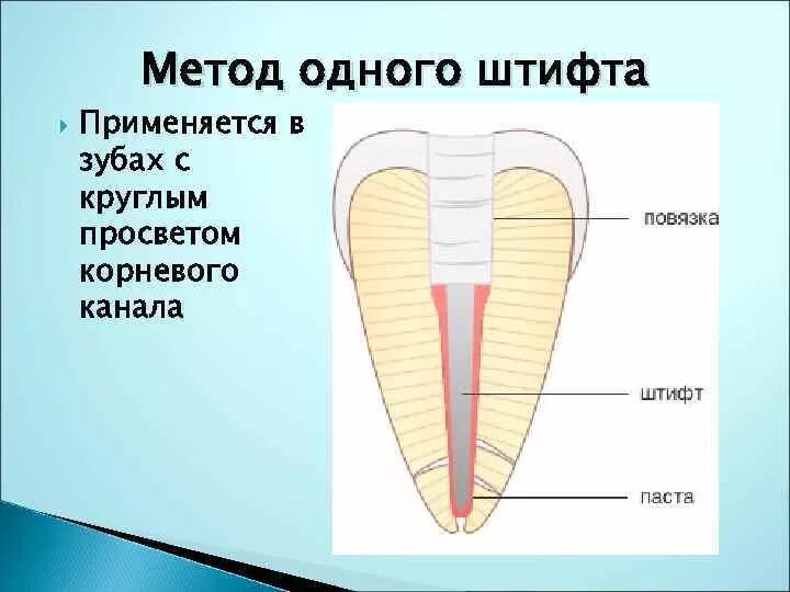 Методы пломбирования корневых. Метод пломбирования штифта. Обтурация корневого канала методом одного штифта. Пломбирование методом 1 штифта. Метод пломбирования корневого канала.