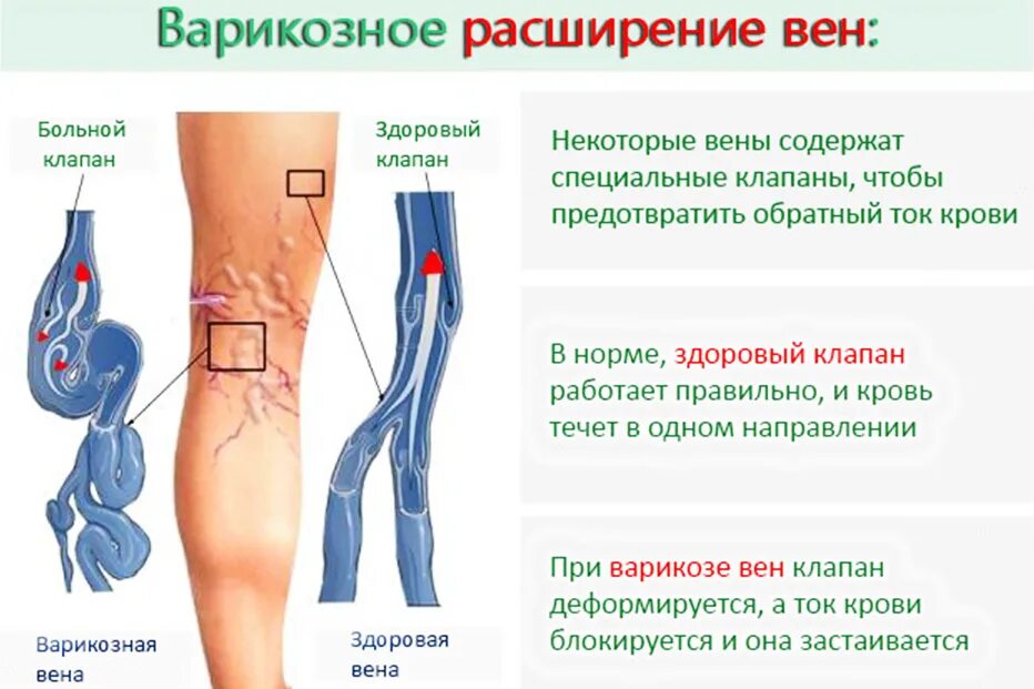 Варикозное расширение вен голени симптомы. Варикозное расширение вен (ВРВ) нижних конечностей. Варикозное заболевания расширение вен нижних конечностей. Варикозное расширение вен нижних конечностей лекция. Чтоб не было тромбы