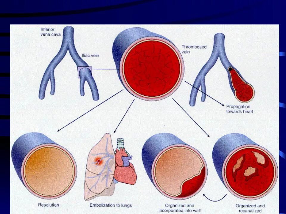 Исходы тромбоза патанатомия. Тромбоэмболия артерии. Тромбоз тэла