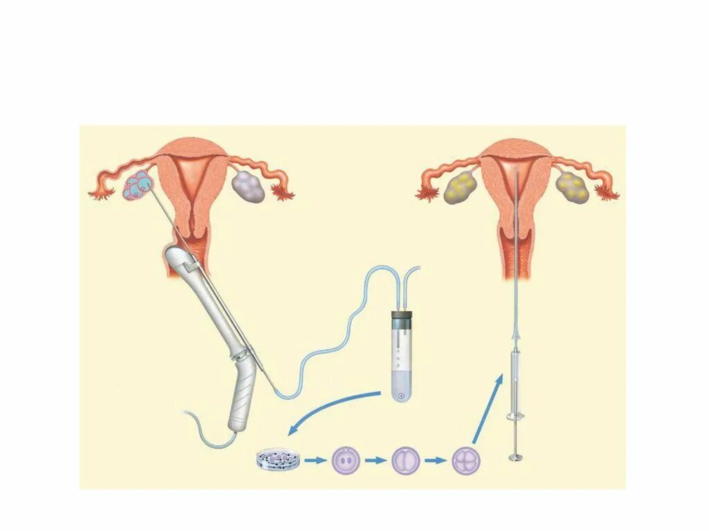 Пункция фолликулов яичника экстракорпоральное оплодотворение. Эко это искусственное оплодотворение. Пункция фолликулов при эко. Искусственная инсеминация.