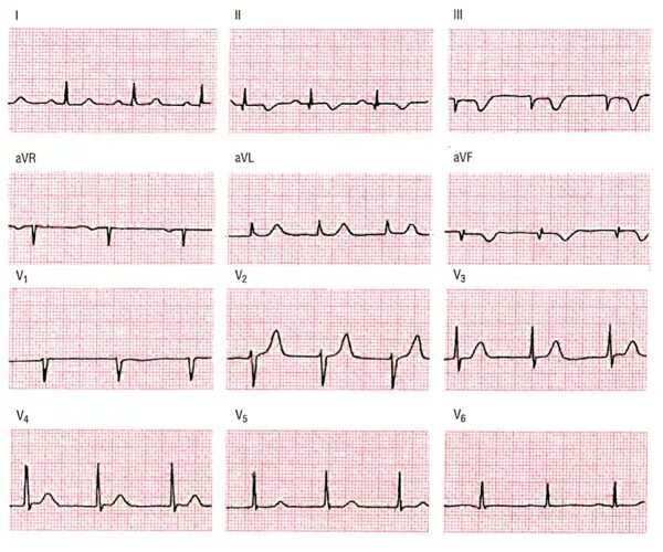 Изменение передней стенки левого желудочка. Нижне диафрагмальный инфаркт миокарда на ЭКГ. ЭКГ изменения при инфаркте миокарда нижней стенки. Инфаркт миокарда Нижне боковой стенки ЭКГ. Задне Нижний инфаркт миокарда ЭКГ.