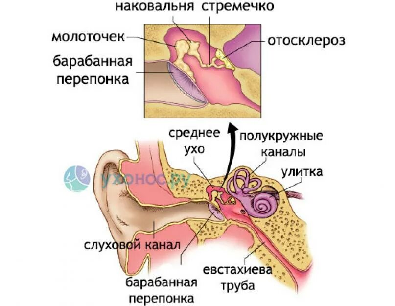 Операция на среднем ухе. Болезни среднего уха отосклероз. Фенестральный отосклероз. Отосклероз барабанная перепонка. Смешанная тугоухость отосклероз.