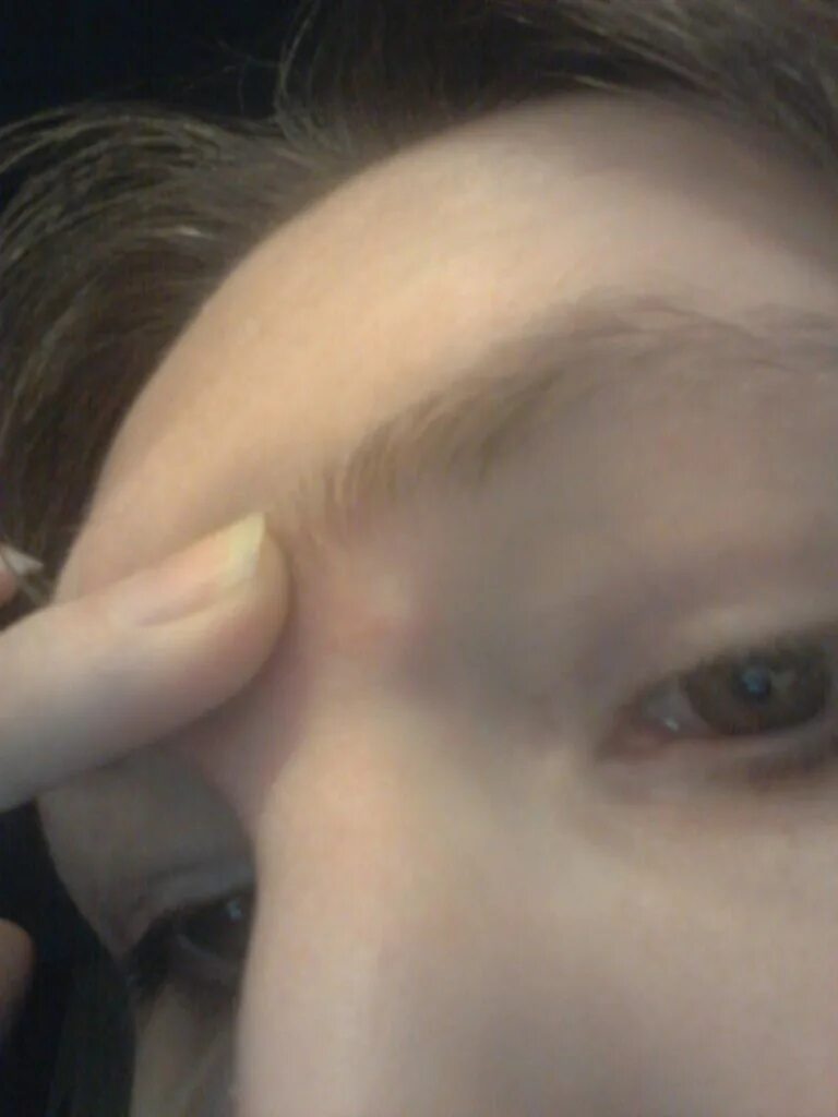 прыщ на переносице слева. родинки на лице значение у женщин. прыщ на переносице слева. карта лица высыпания на лице у женщин. прыщ на переносице слева.