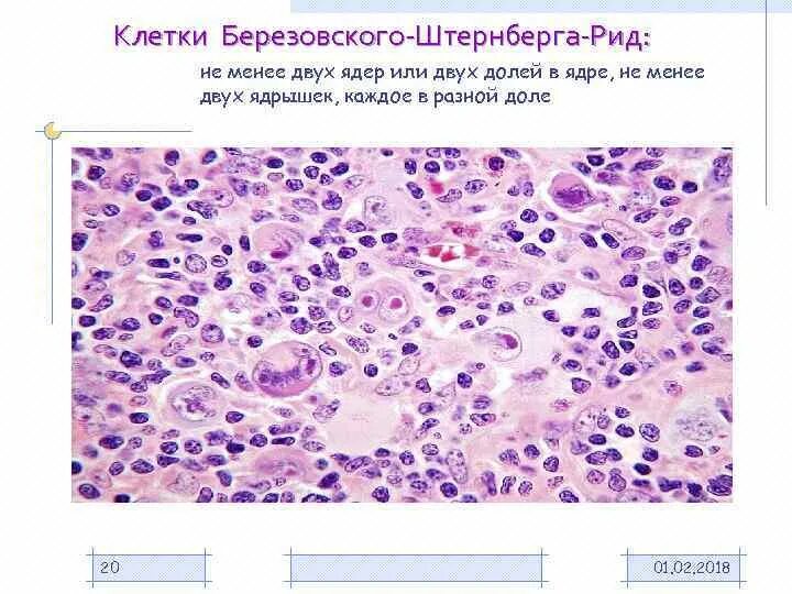 Клетки рида – штернберга препарат. Лимфогранулематоз клетки березовского штернберга. Клетки рида. Клетки рида. Клетки березовского штерн.