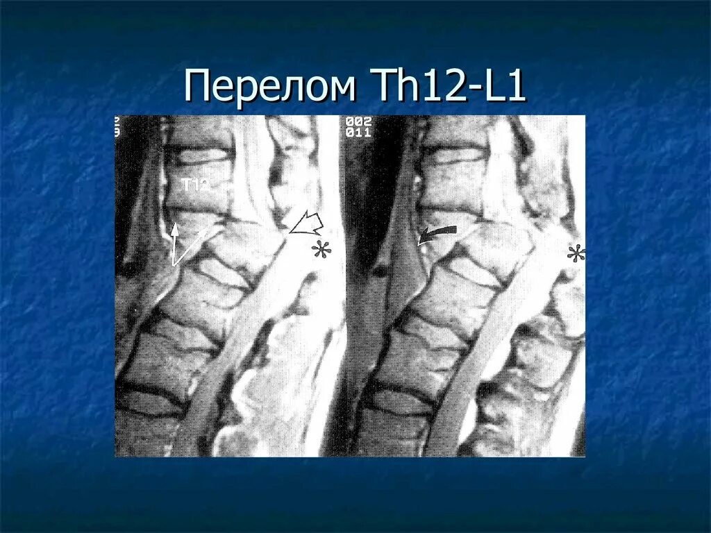 Компрессионный перелом l1 th12. Компрессионный перелом l1 позвонка. Компрессионный перелом позвоночника th12 l3. Компрессионный перелом th12 позвонка. Компрессионный перелом тела 1 1