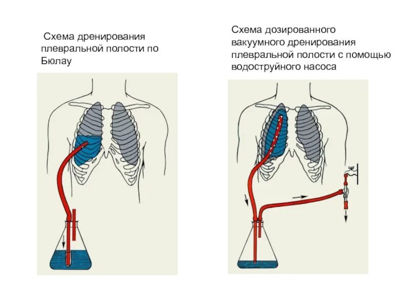 Лечение плевральной полости. Плевральный дренаж Бюлау. Активный дренаж плевральной полости. Система дренирования по Бюлау. Техника Бюлау дренирование.