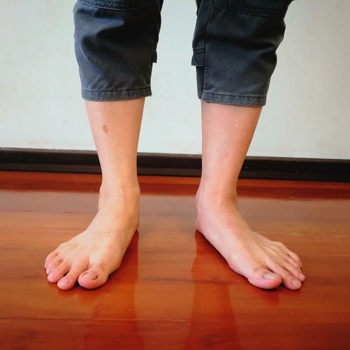 Normal feet