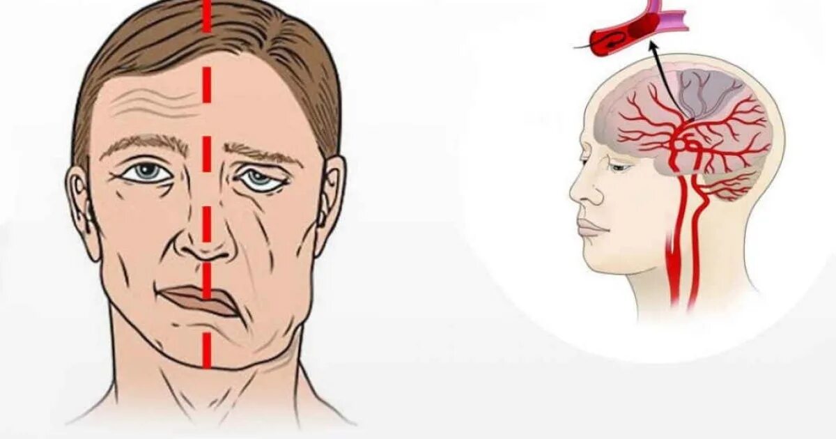 Последствия ишемической атаки мозга. Инсульт картинки. Ишемический инсульт картинки. Исудьт.