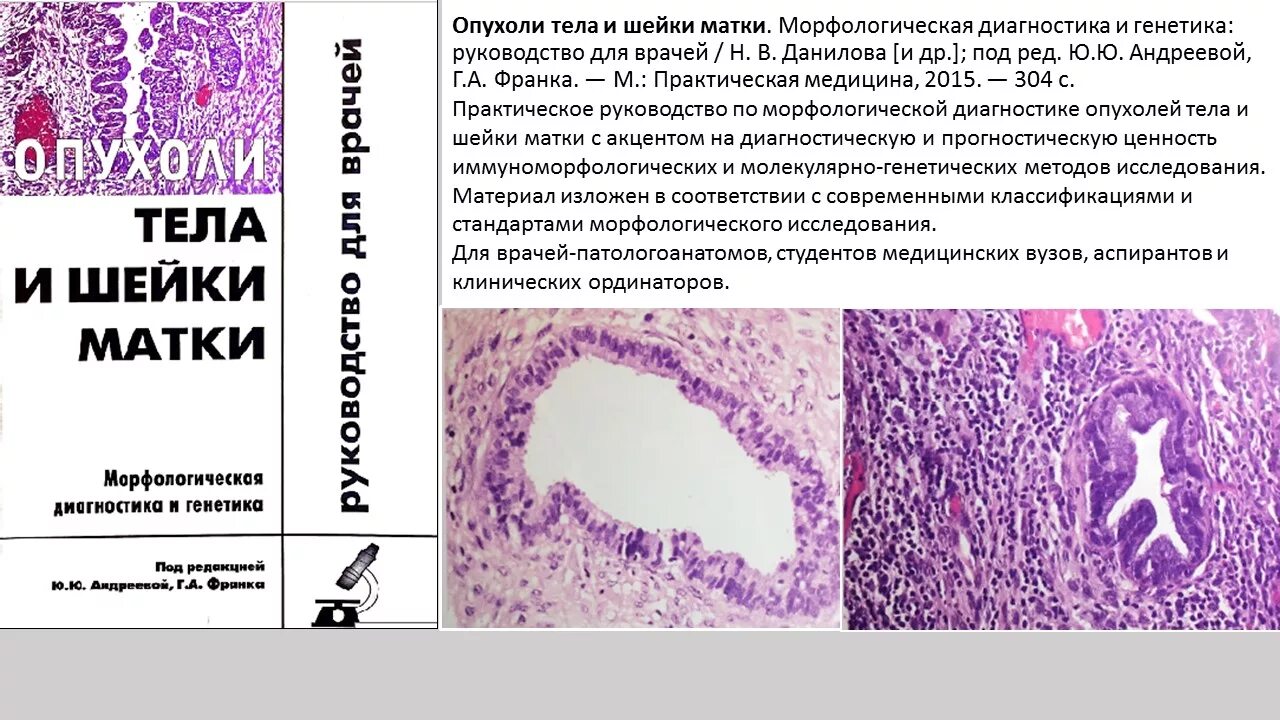 Гистологически рак шейки матки. Дисплазия шейки матки микропрепарат. Гистологически рак шейки матки. Гистологическая классификация ршм. Гистологически рак шейки матки.