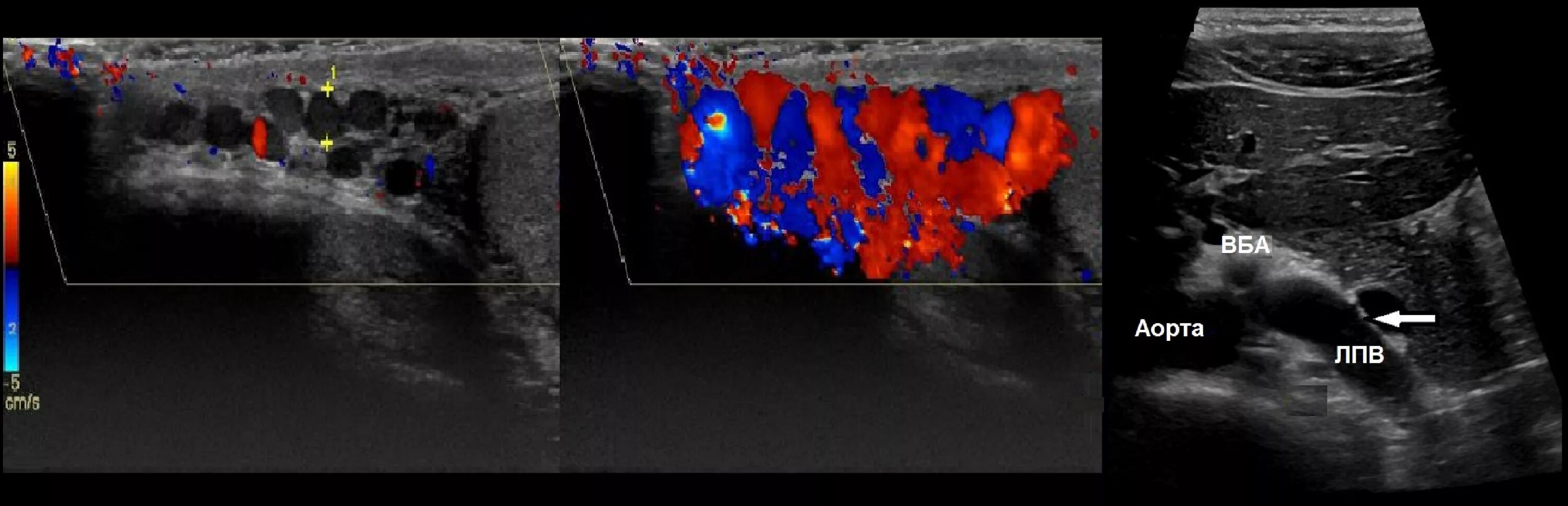 УЗИ вен семенного канатика. Расширение вен семенного канатика на УЗИ. Варикозное расширение вен семенного канатика на УЗИ. УЗИ мошонки варикоцеле 3 степени. Воспаление канатика у мужчин