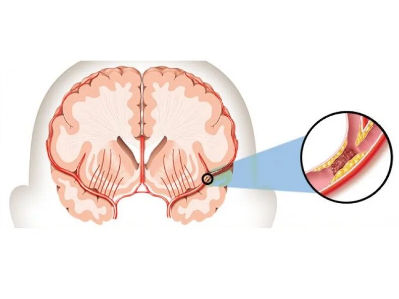 Инсульт. Микроинсульт. Мини инсульт. Инсульт картинки. Головной микроинсульт