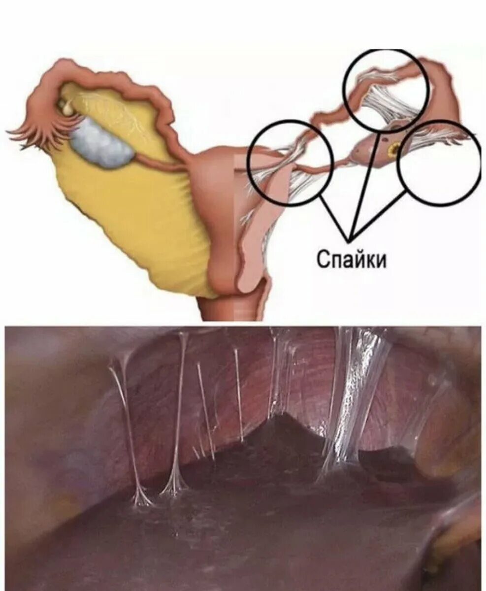 Спаечный процесс малого. Спаечный процесс в Малом тазу. Процесс образования спаек в Малом тазу.
