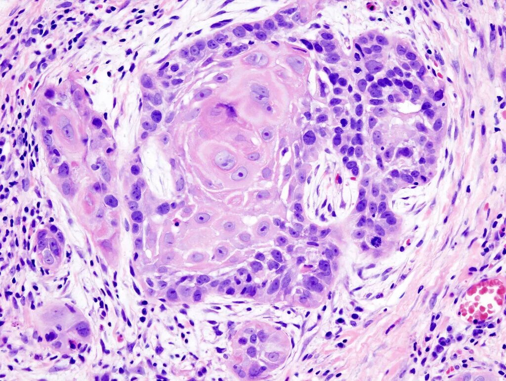 Плоскоклеточная опухоль. Squamous cell carcinoma гистология. цилиндрома гистология. плоскоклеточная карцинома гистология. эритроплазия кейра гистология.