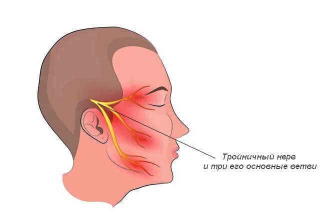 Воспаление тройничного нерва воспаление. Неврит невропатия тройничного нерва. Нерв тройничный лицевой воспалился. Неврит нижнечелюстного нерва. Боли тройничного лицевого нерва