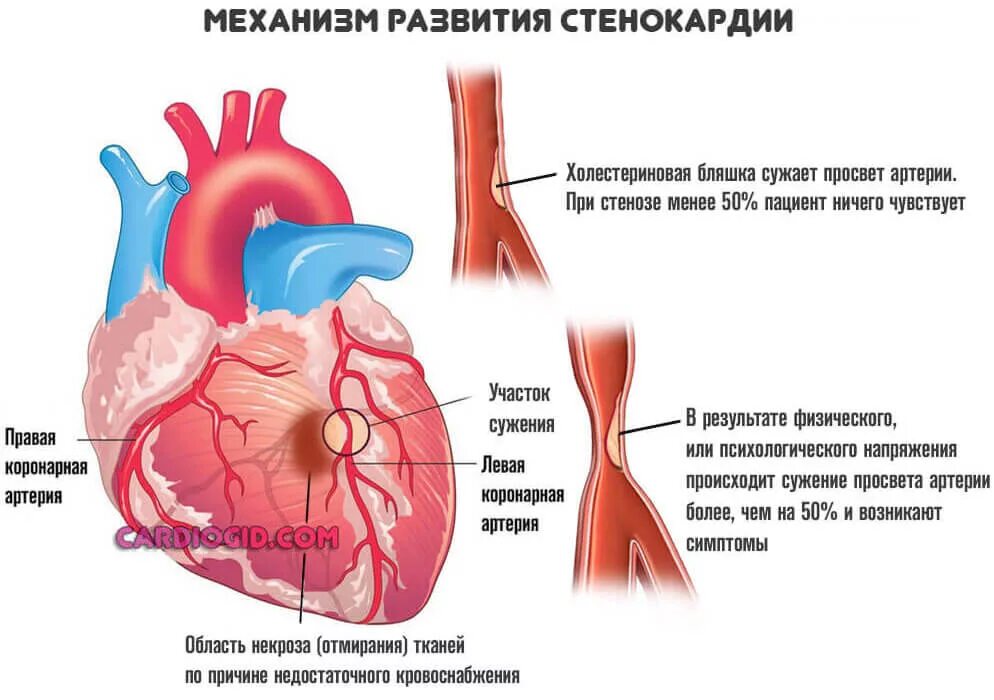 Стеноз спазм