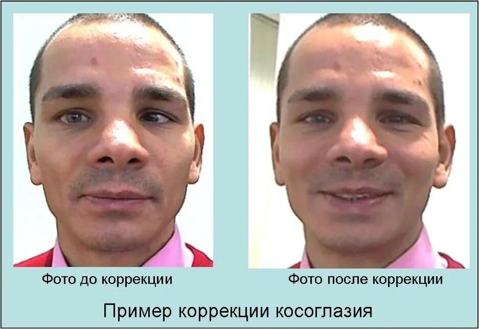 Амблиопия у взрослых. Косоглазие до и после операции. Расходящееся косоглазие у взрослых. Косоглазие легкой степени. Хирургическое исправление косоглазия.