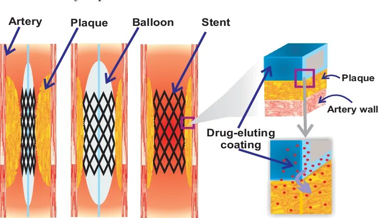 Лекарственный стент. Стенты с лекарственным покрытием. Стент коронарный с лекарственным покрытием. Периферический стент с лекарственным покрытием.