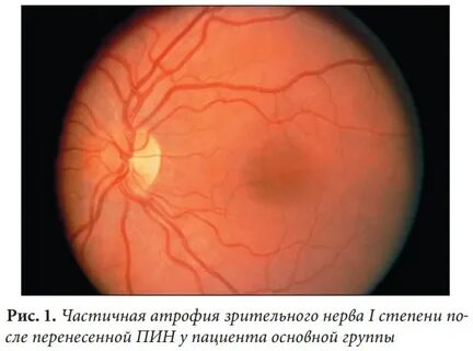 Поверхностная атрофия