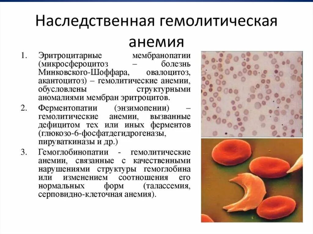 Наследственная анемия Минковского Шоффара. Эритроциты при болезни Минковского Шоффара. Гемолитическая болезнь Минковского Шоффара. Анемия Минковского-Шоффара симптомы.