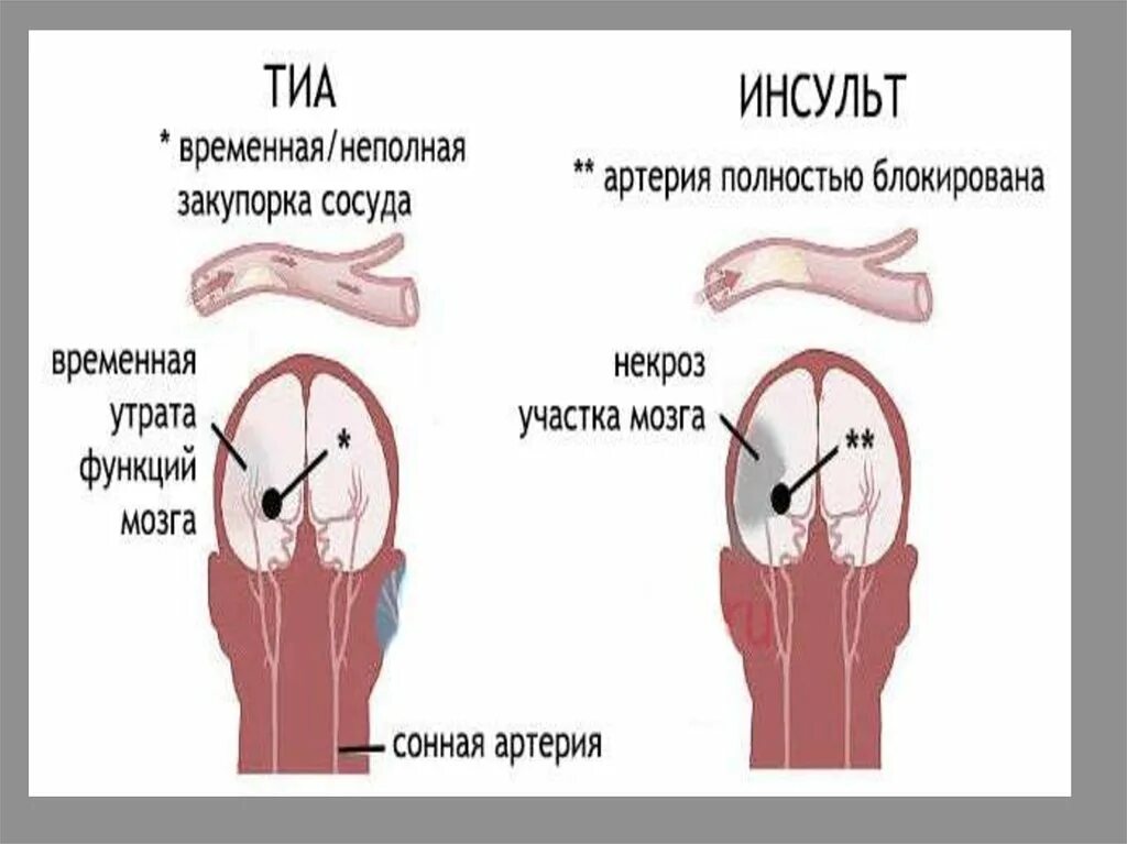 Транзиторные ишемические атаки. Ишемическая атака и инсульт разница. Ишемическая атака головного мозга. Транзиторная ишемическая атака симптомы.