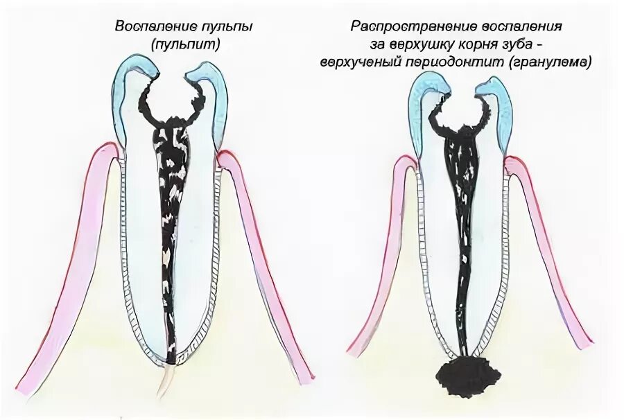 Гранулема зуба гистология.