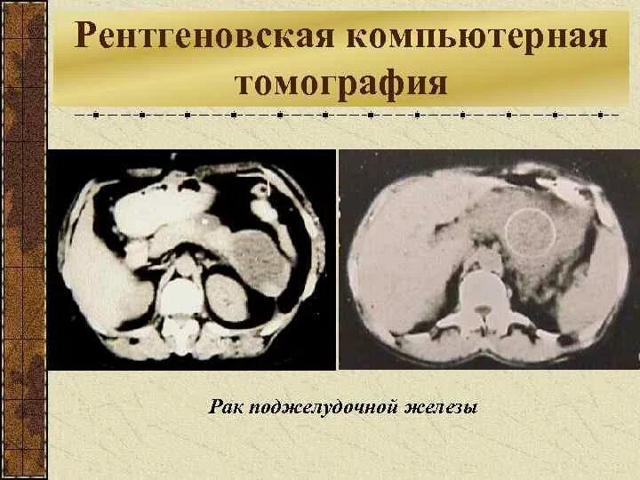 Что такое кт при онкологии