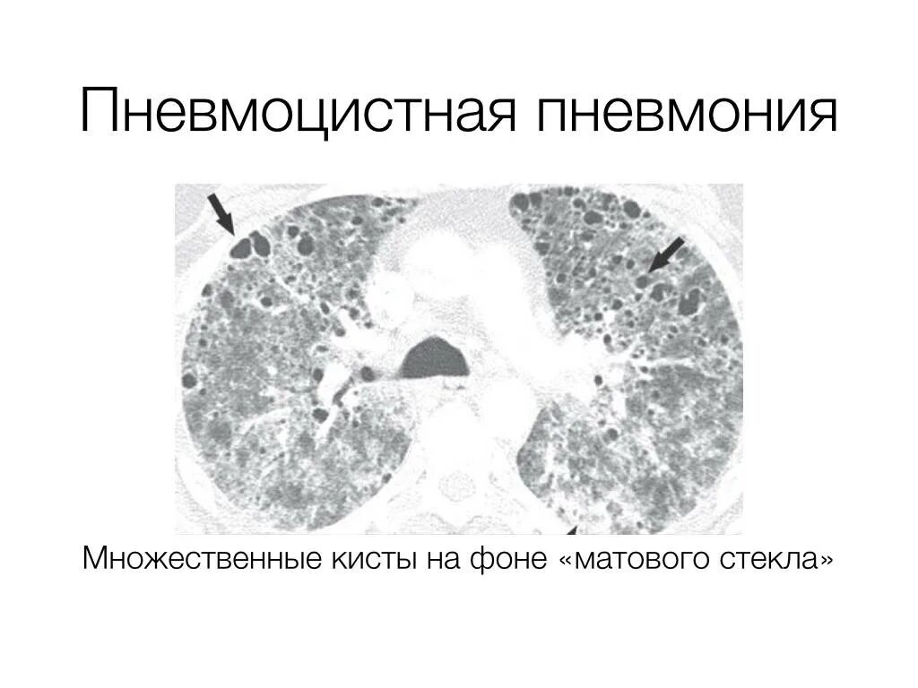 Пневмоцистная пневмония кт. Пневмоцистная пневмония на кт. Пневмоцистная пневмония патанатомия. Пневмоцистная пневмония кт. Пневмоцистная пневмония кт.