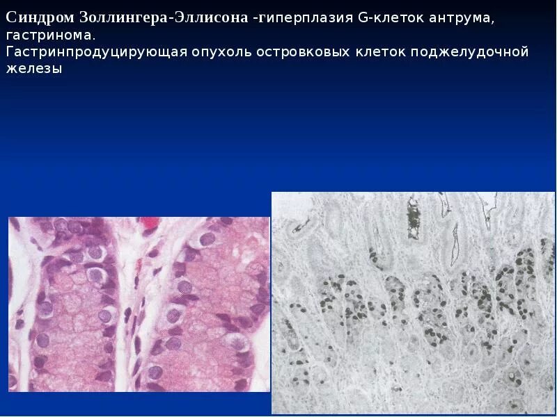 Синдром эллисона. Опухоль золлингера-эллисона. гастринома гистология. гастринпродуцирующая опухоль (гастринома).