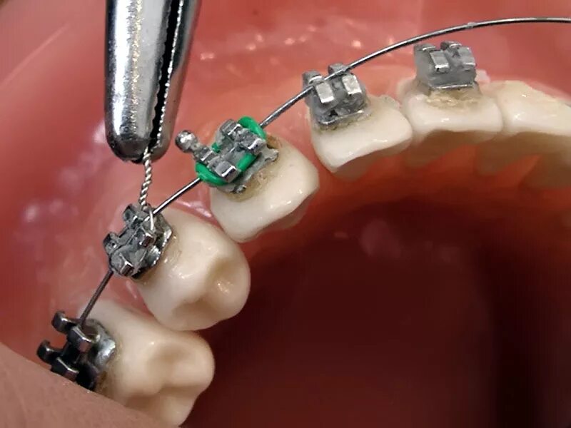 Ортодонтия в стоматологии. 3 зуба установить