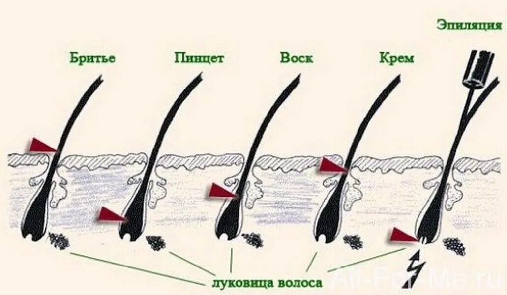 Электроэпиляция зоны бикини схема. Волос с волосяной луковицей. Выдергивание волоса с луковицей.